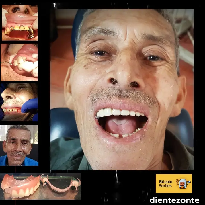 Historia de Bitcoin Smiles: Misael. Lee su historia en Bitcoin Smiles y ayúdanos a recaudar más fondos para la atención dental gratuita