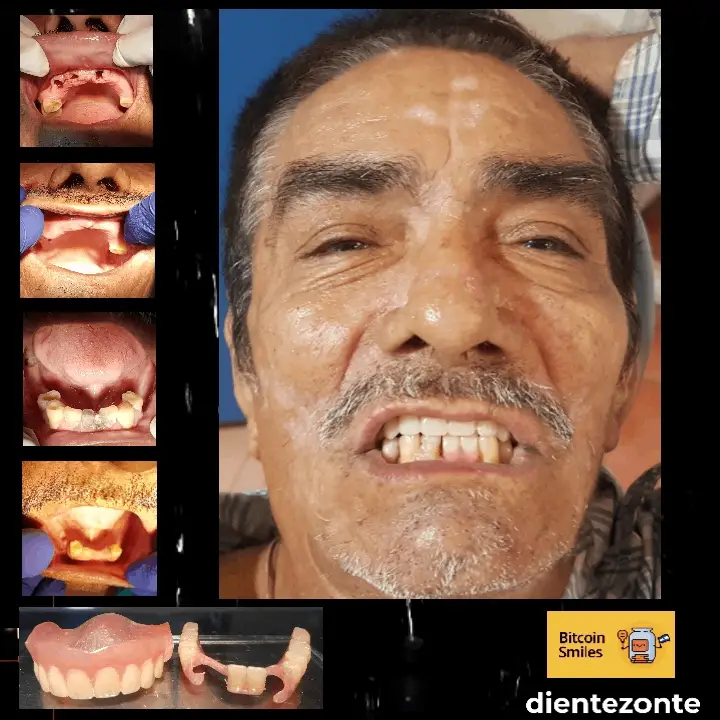 Bitcoin Smiles Story: José Don Chema. Read his story on Bitcoin Smiles and help us to raise more funds for free dental care