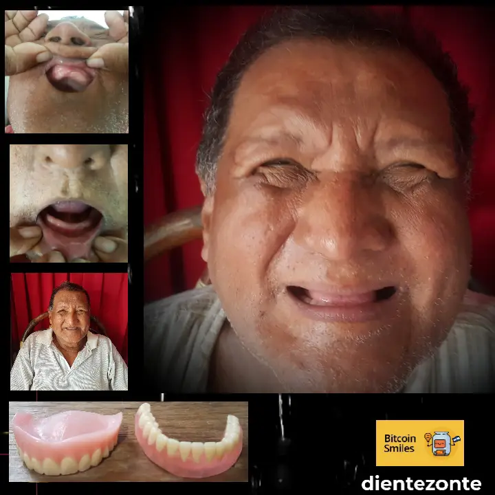 Historia de Bitcoin Smiles: Chepito. Lee su historia en Bitcoin Smiles y ayúdanos a recaudar más fondos para la atención dental gratuita