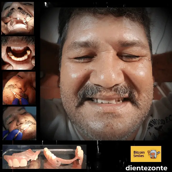Bitcoin Smiles Story: Jesús. Read his story on Bitcoin Smiles and help us to raise more funds for free dental care