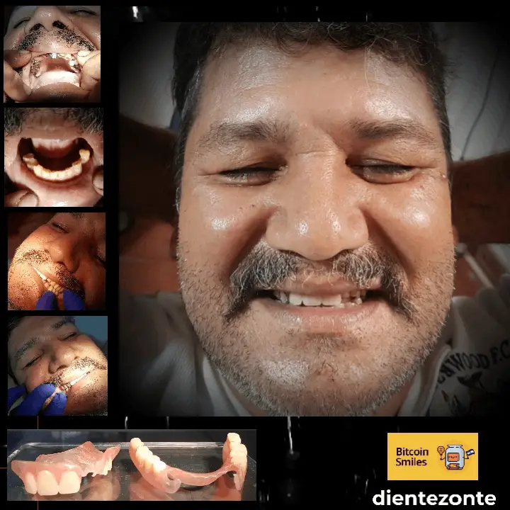 Historia de Bitcoin Smiles: Jesús. Lee su historia en Bitcoin Smiles y ayúdanos a recaudar más fondos para la atención dental gratuita