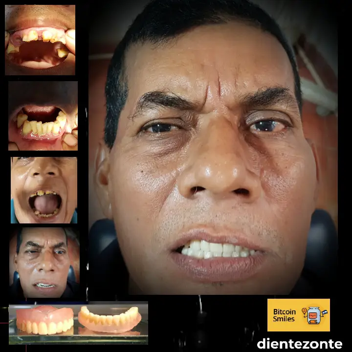 Bitcoin Smiles Story: Manuel. Read his story on Bitcoin Smiles and help us to raise more funds for free dental care