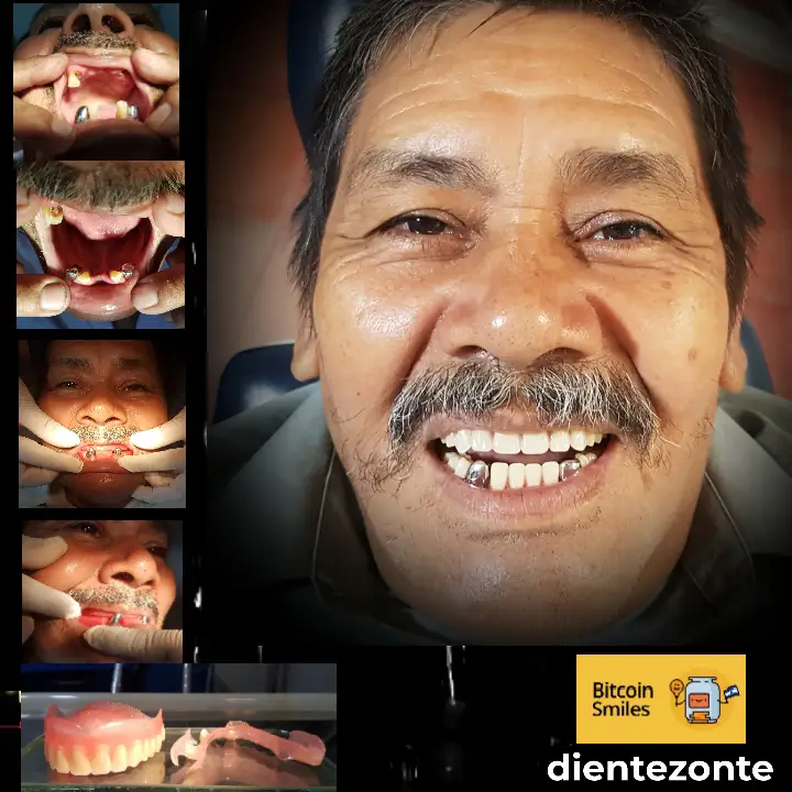 Historia de Bitcoin Smiles: Maxmilian. Lee su historia en Bitcoin Smiles y ayúdanos a recaudar más fondos para la atención dental gratuita