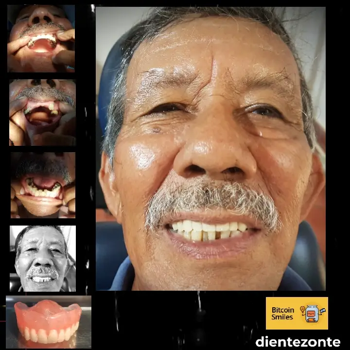 Bitcoin Smiles Story: Paolo. Read his story on Bitcoin Smiles and help us to raise more funds for free dental care