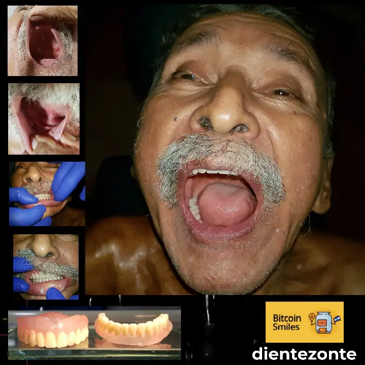 Historia de Bitcoin Smiles: Raúl. Lee su historia en Bitcoin Smiles y ayúdanos a recaudar más fondos para la atención dental gratuita