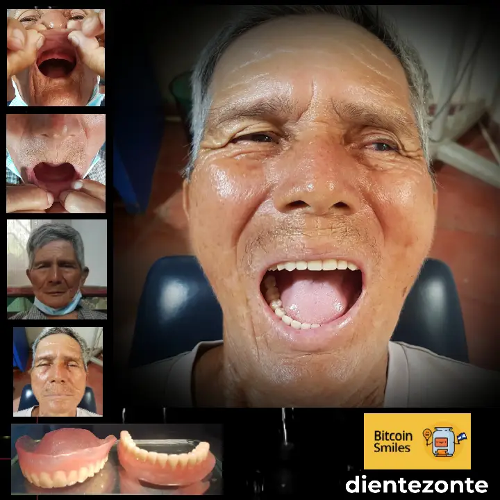 La historia de Bitcoin Smiles: Santos. Santos tiene 68 años y casi tres décadas de problemas con su dentadura. Bitcoin Smiles resolvió esto!